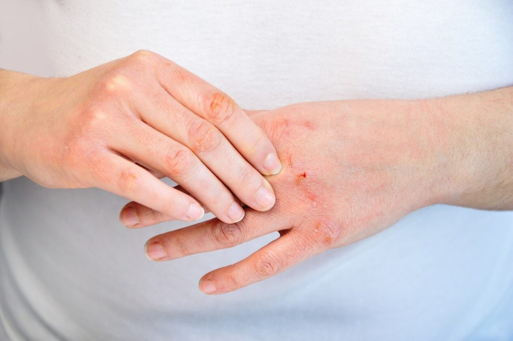 Contact Dermatitis Causes Treatment And Symptoms