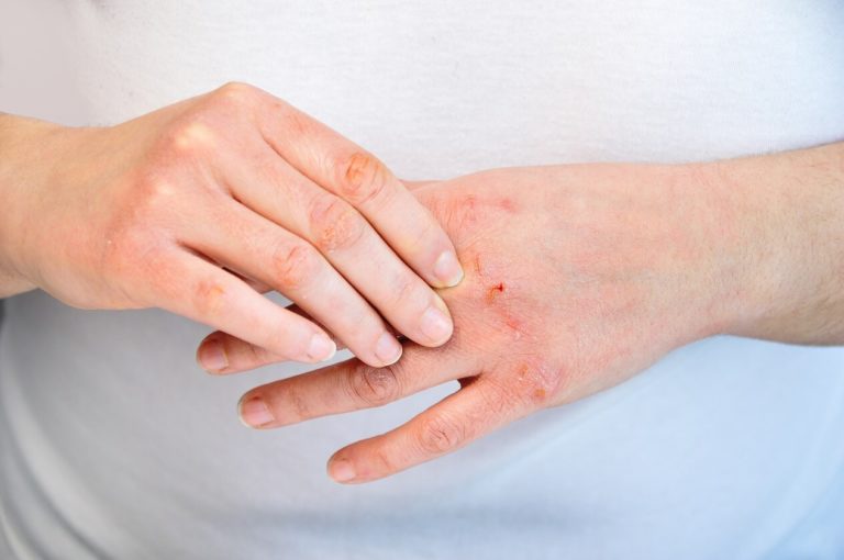 Contact Dermatitis Causes Treatment And Symptoms 